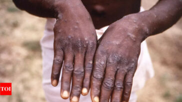 Pakistan government dismisses report of monkeypox case in country: Report