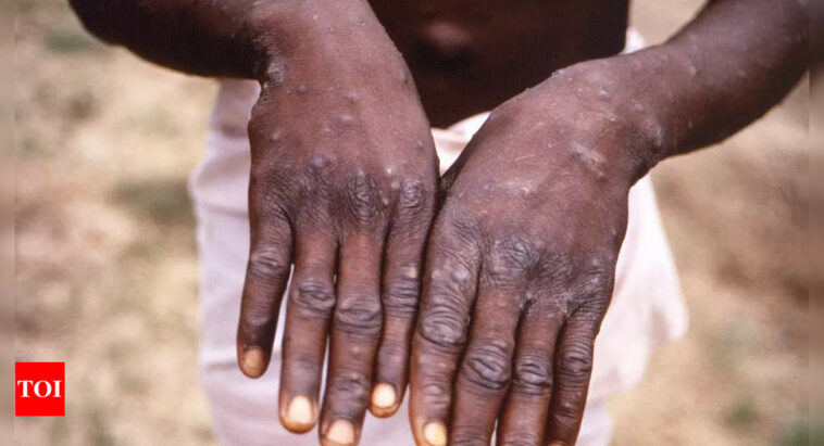 Pakistan government dismisses report of monkeypox case in country: Report