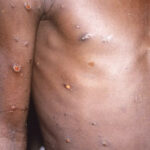 UK confirms local transmission of monkeypox