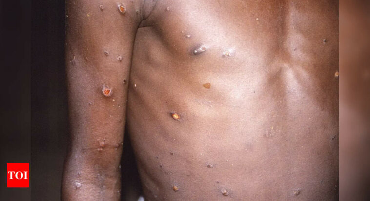 UK confirms local transmission of monkeypox