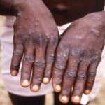 WHO aims to contain monkeypox outbreak by minimizing human transmission