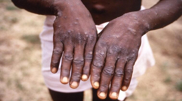 WHO aims to contain monkeypox outbreak by minimizing human transmission