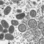 2 monkeypox strains in US suggest possible undetected spread