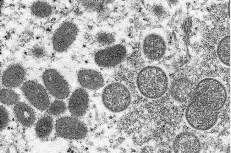 2 monkeypox strains in US suggest possible undetected spread