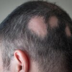 News Picture: FDA Approves First Pill to Treat Severe Alopecia