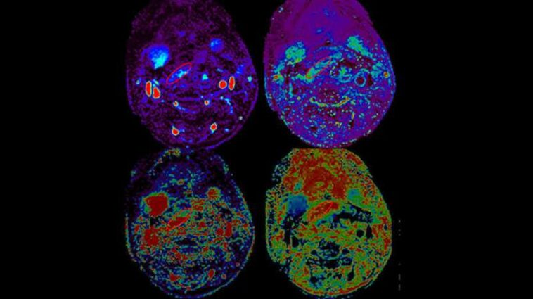 How MRI and CT predict flap failure after head and neck reconstructive cancer surgery