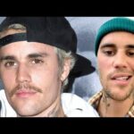 Justin Bieber Shares UPDATE After Revealing His Face Is Paralyzed