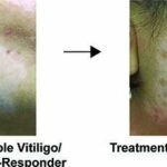 New UCI-led study reveals characteristics of stable Vitiligo skin disease