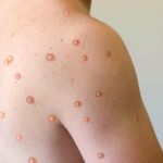 U.S. monkeypox cases now at 21, two strains identified