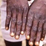 WHO drops endemic country distinction for monkeypox