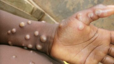 15 labs across country to start testing for monkeypox