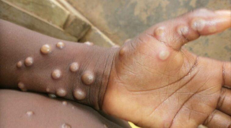 15 labs across country to start testing for monkeypox