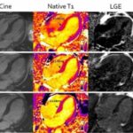 Advanced MRI benefits patients with heart stiffening disease