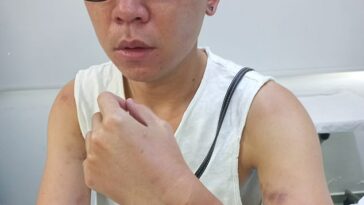 Jonathan Kan said he was attacked and verbally abused by Cypriot police in September 2021 due to his ethnicity - with the ordeal leaving him with PTSD and £7,000 in debt. Pictured: Mr Kan holds up his arm showing injuries to his arm and wrist