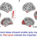 Children who lack sleep may experience detrimental impact on brain and cognitive development that persists over time