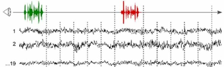 Hidden Consciousness Detected with EEG Predicts Recovery of Unresponsive Patients