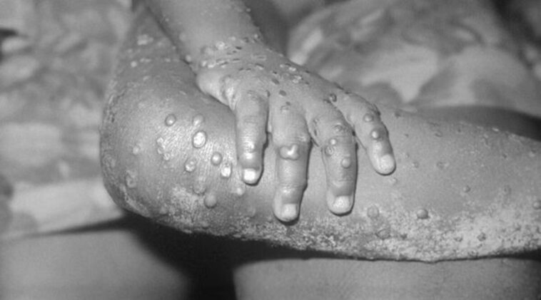 monkey pox