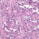 Study reveals new therapeutic target for aggressive type of rhabdomyosarcoma