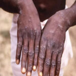 WHO: 18,000 cases of Monkeypox globally from 78 countries