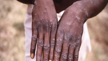 WHO: 18,000 cases of Monkeypox globally from 78 countries