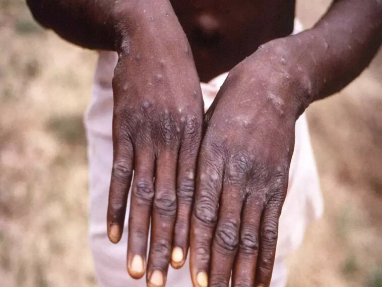 WHO: 18,000 cases of Monkeypox globally from 78 countries