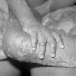 World Health Organization Declares Monkeypox A Public Health Emergency As Global Cases Pass 15K