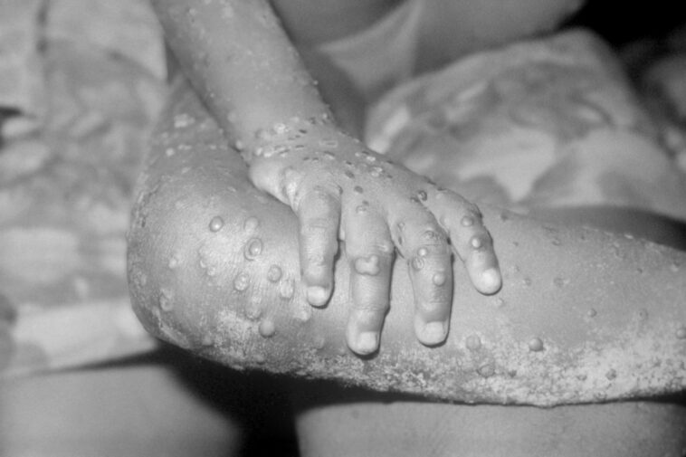 World Health Organization Declares Monkeypox A Public Health Emergency As Global Cases Pass 15K