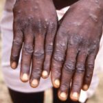 10 monkeypox cases in country since first case reported in July; no spread, says expert