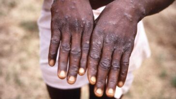 10 monkeypox cases in country since first case reported in July; no spread, says expert