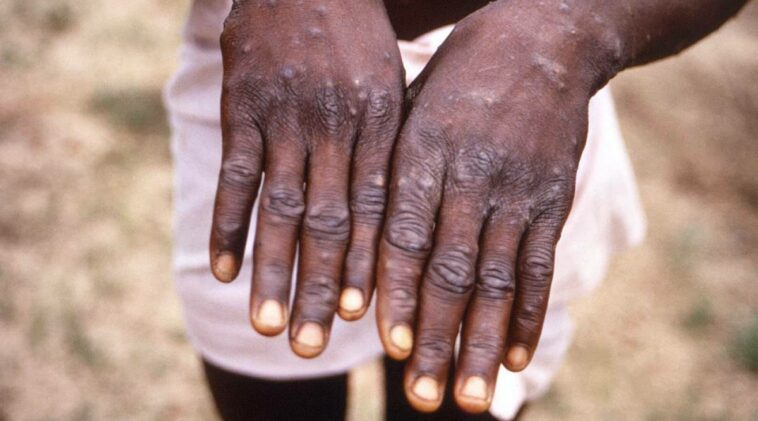 10 monkeypox cases in country since first case reported in July; no spread, says expert