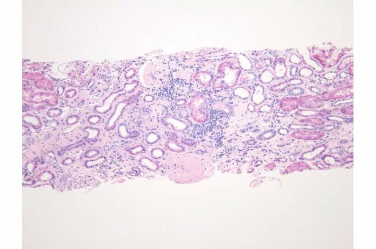 Aldosterone linked to increased risk of chronic kidney disease progression and end-stage kidney disease