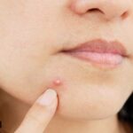 Dermatologist shares hidden reasons behind your acne: ‘They aren’t that obvious’