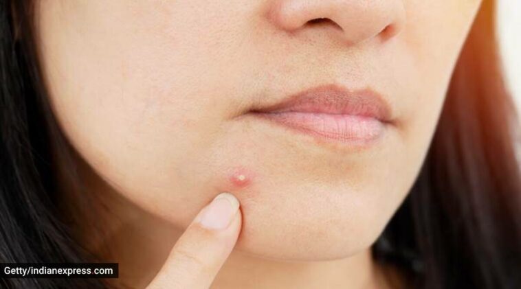 Dermatologist shares hidden reasons behind your acne: ‘They aren’t that obvious’