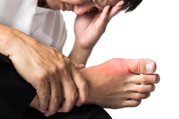 News Picture: Gout Flare-Ups Could Raise Heart Risk for Weeks After