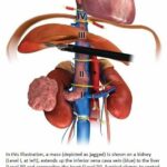 Robotic kidney cancer surgery shows desirable outcomes in study