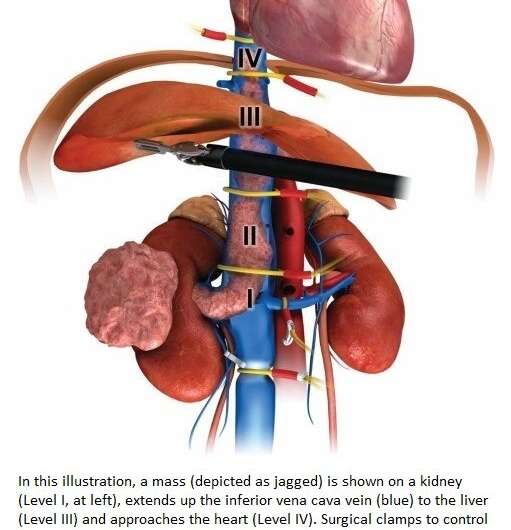 Robotic kidney cancer surgery shows desirable outcomes in study