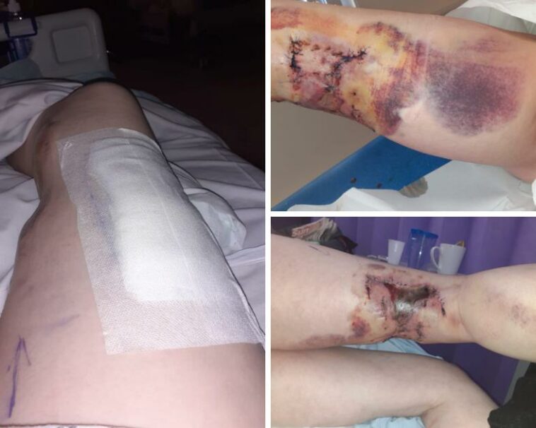 Woman calls for law change after being viciously savaged by 'frenzied' dog