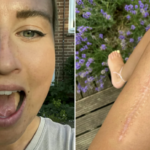 pictures of a Woman who had part of her tongue removed and remade from her leg after mouth cancer diagnosis