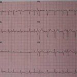 atrial fibrillation