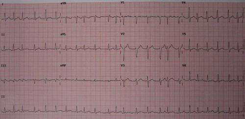 atrial fibrillation