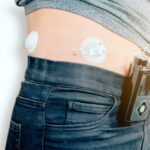 Clinical trial shows bionic pancreas improves type 1 diabetes management compared to standard insulin delivery method