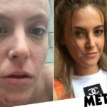 Eczema cream withdrawal leaves woman unable to leave the house