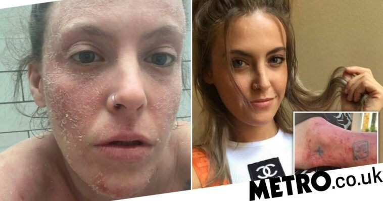 Eczema cream withdrawal leaves woman unable to leave the house