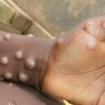 Experts: Surveillance of monkeypox cases can be strengthened by screening at-risk groups