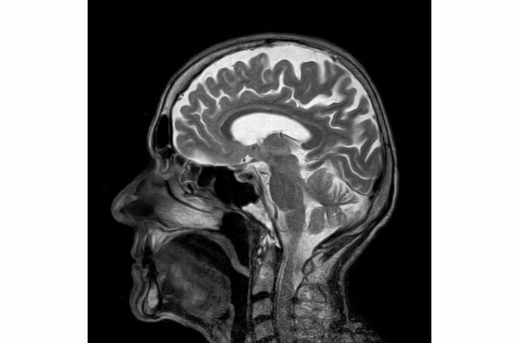 brain MRI