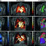 Lasting lung damage seen in children and teens after COVID