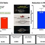 Newly developed endovascular catheter shows unprecedented ability to treat pulmonary artery obstruction