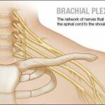 Surgical options to treat brachial plexus injuries