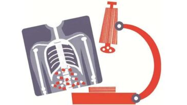 Tuberculosis, tuberculosis cases, COVID-19, Covid pandemic, Indian express, Opinion, Editorial, Current Affairs