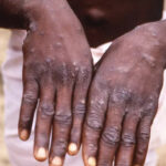 US warns monkeypox could mutate to resist antiviral drug